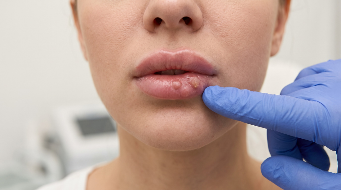 Retiro de biopolímeros en labios: precisión en una zona pequeña